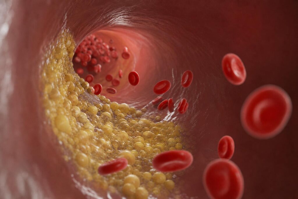 Triglycerides in Canada: What Your Numbers Mean, Why They Matter, and How to Lower Them Safely