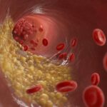 Triglycerides in Canada: What Your Numbers Mean, Why They Matter, and How to Lower Them Safely