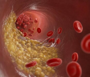 Triglycerides in Canada: What Your Numbers Mean, Why They Matter, and How to Lower Them Safely