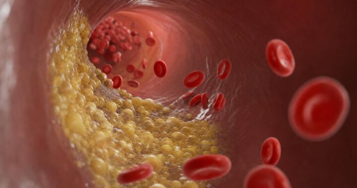 Triglycerides in Canada: What Your Numbers Mean, Why They Matter, and How to Lower Them Safely